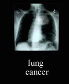 Read my dissertation on Lung Cancer